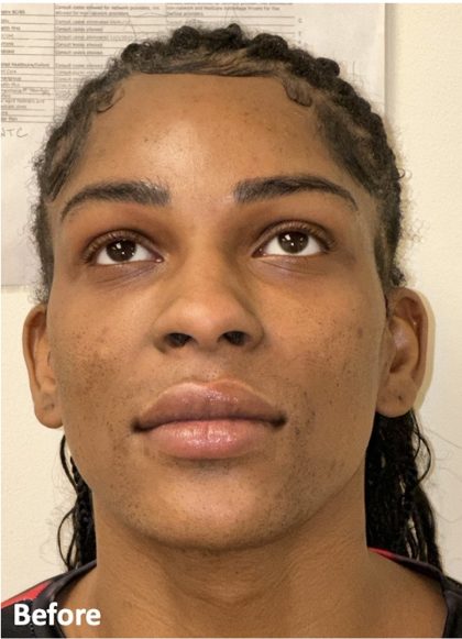 Facial Feminization Before & After Patient #2210