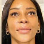 Facial Feminization Before & After Patient #2210