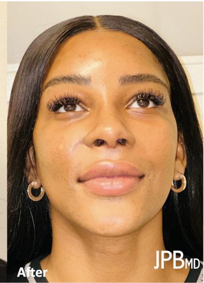 Facial Feminization Before & After Patient #2210