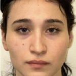 Facial Feminization Before & After Patient #2216