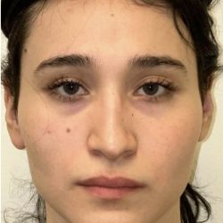 Facial Feminization Before & After Patient #2216