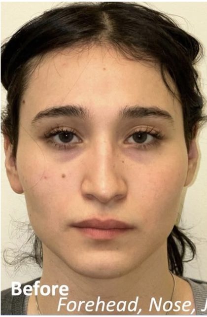 Facial Feminization Before & After Patient #2216