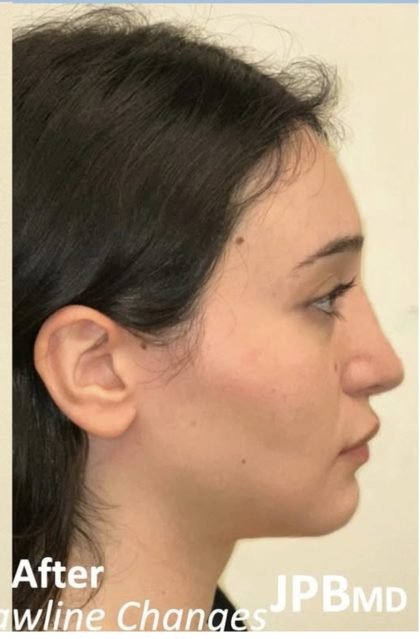 Facial Feminization Before & After Patient #2216