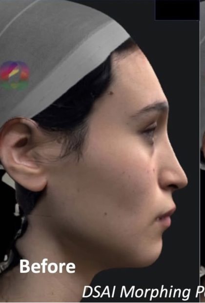 Facial Feminization Before & After Patient #2216