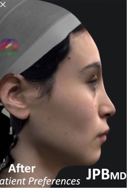 Facial Feminization Before & After Patient #2216