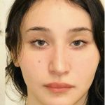 Facial Feminization Before & After Patient #2216