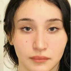 Facial Feminization Before & After Patient #2216