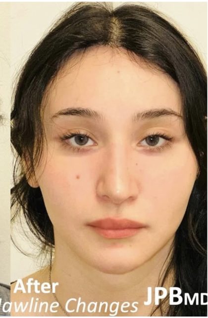 Facial Feminization Before & After Patient #2216