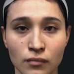 Facial Feminization Before & After Patient #2216