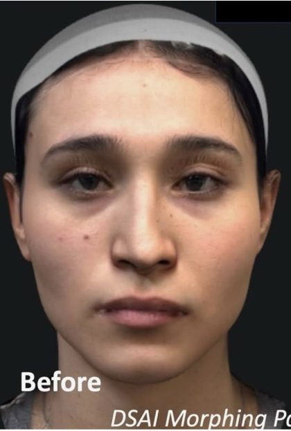 Facial Feminization Before & After Patient #2216