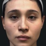 Facial Feminization Before & After Patient #2216