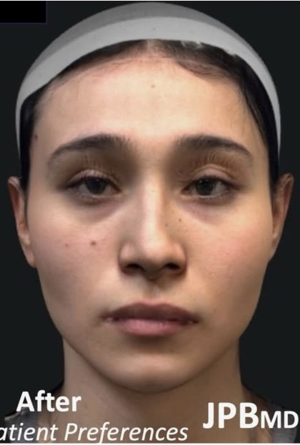 Facial Feminization Before & After Patient #2216