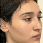 Facial Feminization Before & After Patient #2216