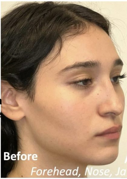 Facial Feminization Before & After Patient #2216