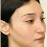 Facial Feminization Before & After Patient #2216