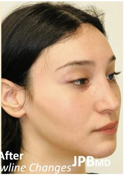 Facial Feminization Before & After Patient #2216