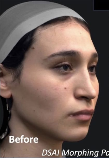 Facial Feminization Before & After Patient #2216