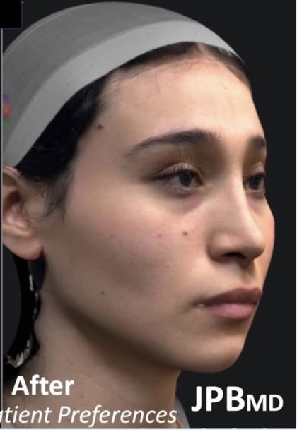 Facial Feminization Before & After Patient #2216