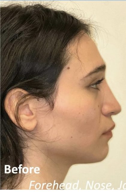 Facial Feminization Before & After Patient #2216