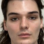 Facial Feminization Before & After Patient #2194