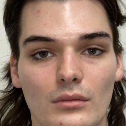 Facial Feminization Before & After Patient #2194