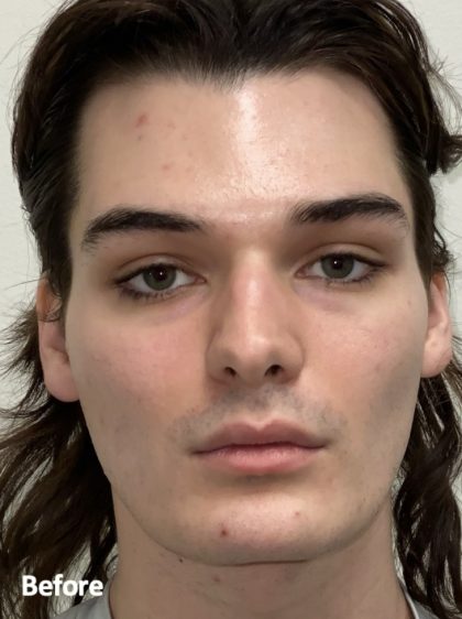Facial Feminization Before & After Patient #2194