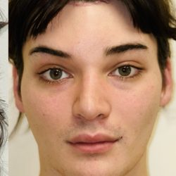 Facial Feminization Before & After Patient #2194
