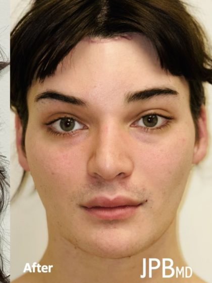 Facial Feminization Before & After Patient #2194