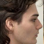 Facial Feminization Before & After Patient #2194