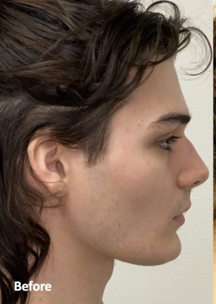 Facial Feminization Before & After Patient #2194