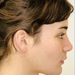 Facial Feminization Before & After Patient #2194