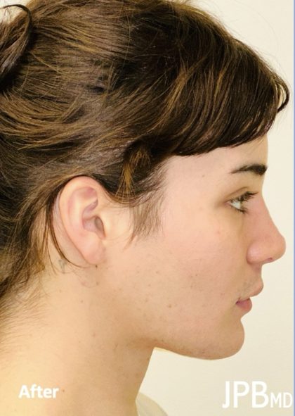 Facial Feminization Before & After Patient #2194