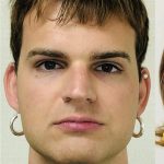 Facial Feminization Before & After Patient #2219