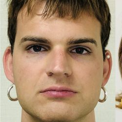 Facial Feminization Before & After Patient #2219