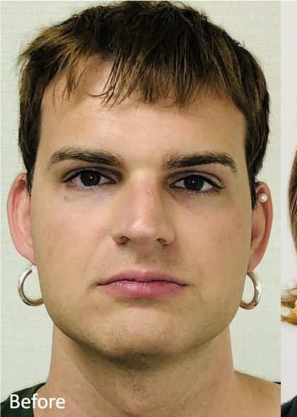 Facial Feminization Before & After Patient #2219