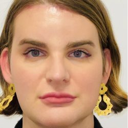 Facial Feminization Before & After Patient #2219
