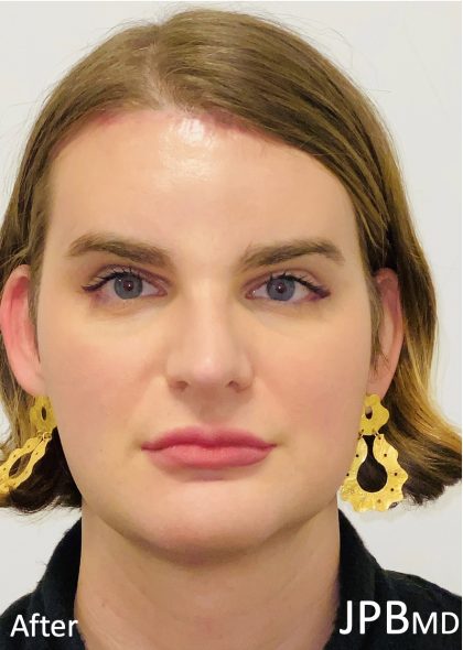Facial Feminization Before & After Patient #2219