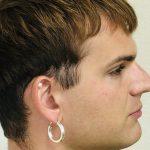 Facial Feminization Before & After Patient #2219