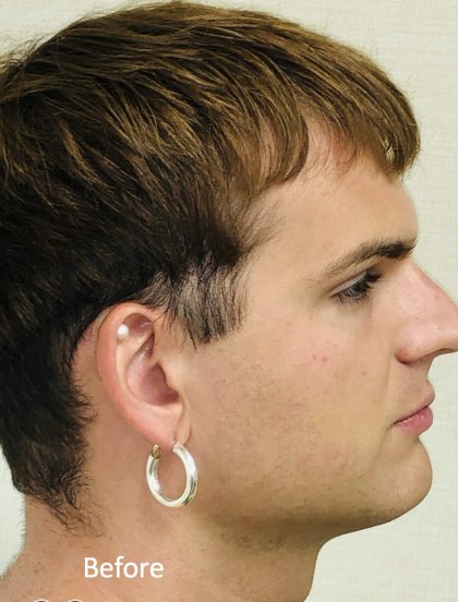 Facial Feminization Before & After Patient #2219