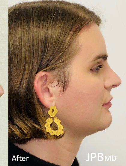 Facial Feminization Before & After Patient #2219