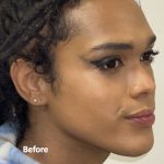 Facial Feminization Before & After Patient #2220