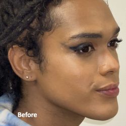 Facial Feminization Before & After Patient #2220