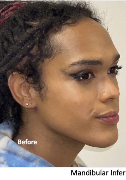 Facial Feminization Before & After Patient #2220
