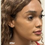 Facial Feminization Before & After Patient #2220