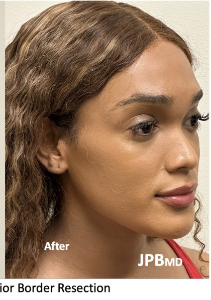 Facial Feminization Before & After Patient #2220