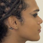 Facial Feminization Before & After Patient #2220