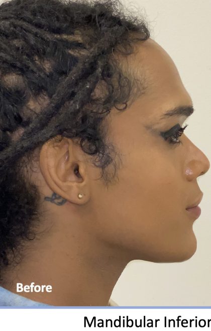 Facial Feminization Before & After Patient #2220