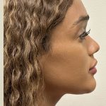 Facial Feminization Before & After Patient #2220