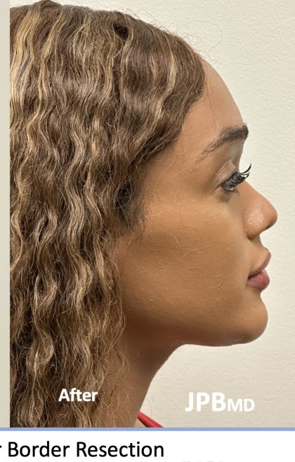 Facial Feminization Before & After Patient #2220