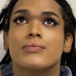 Facial Feminization Before & After Patient #2220